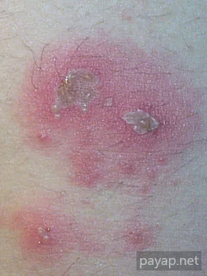 帯状疱疹(ヘルペス)